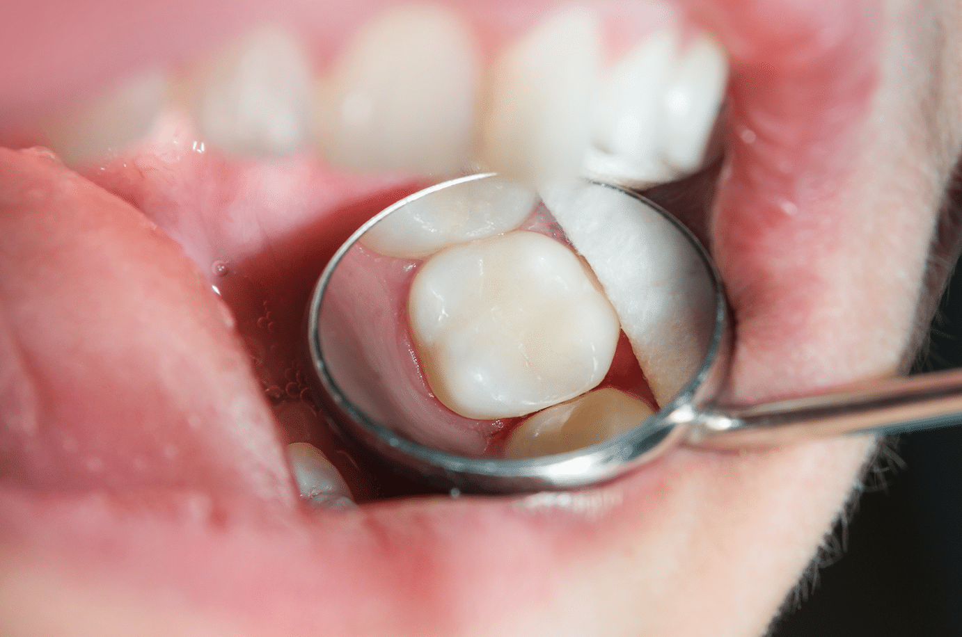 DENTAL CARIES TREATMENTS PART I Keith A. Hoover, April A. Yanda