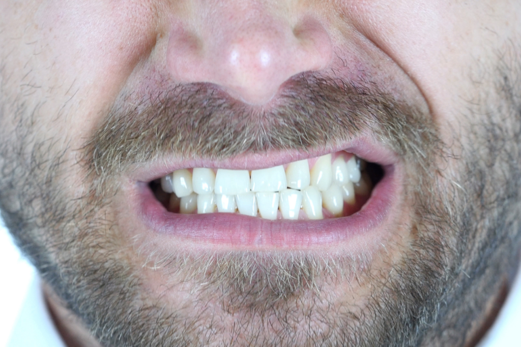 DENTAL HEALTH AND TEETH GRINDING (BRUXISM)