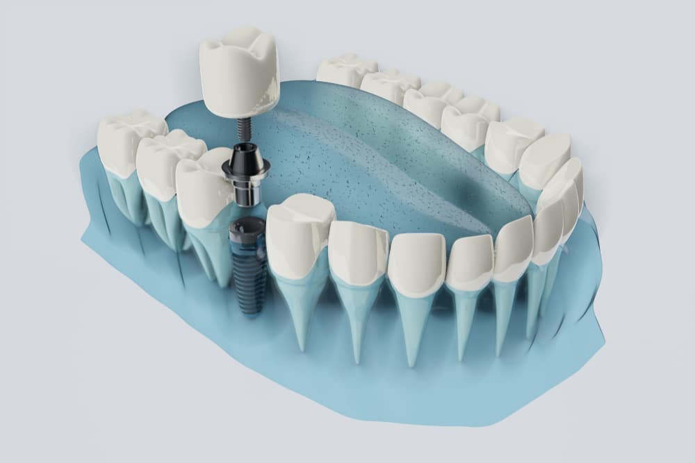 BENEFITS OF DENTAL IMPLANTS