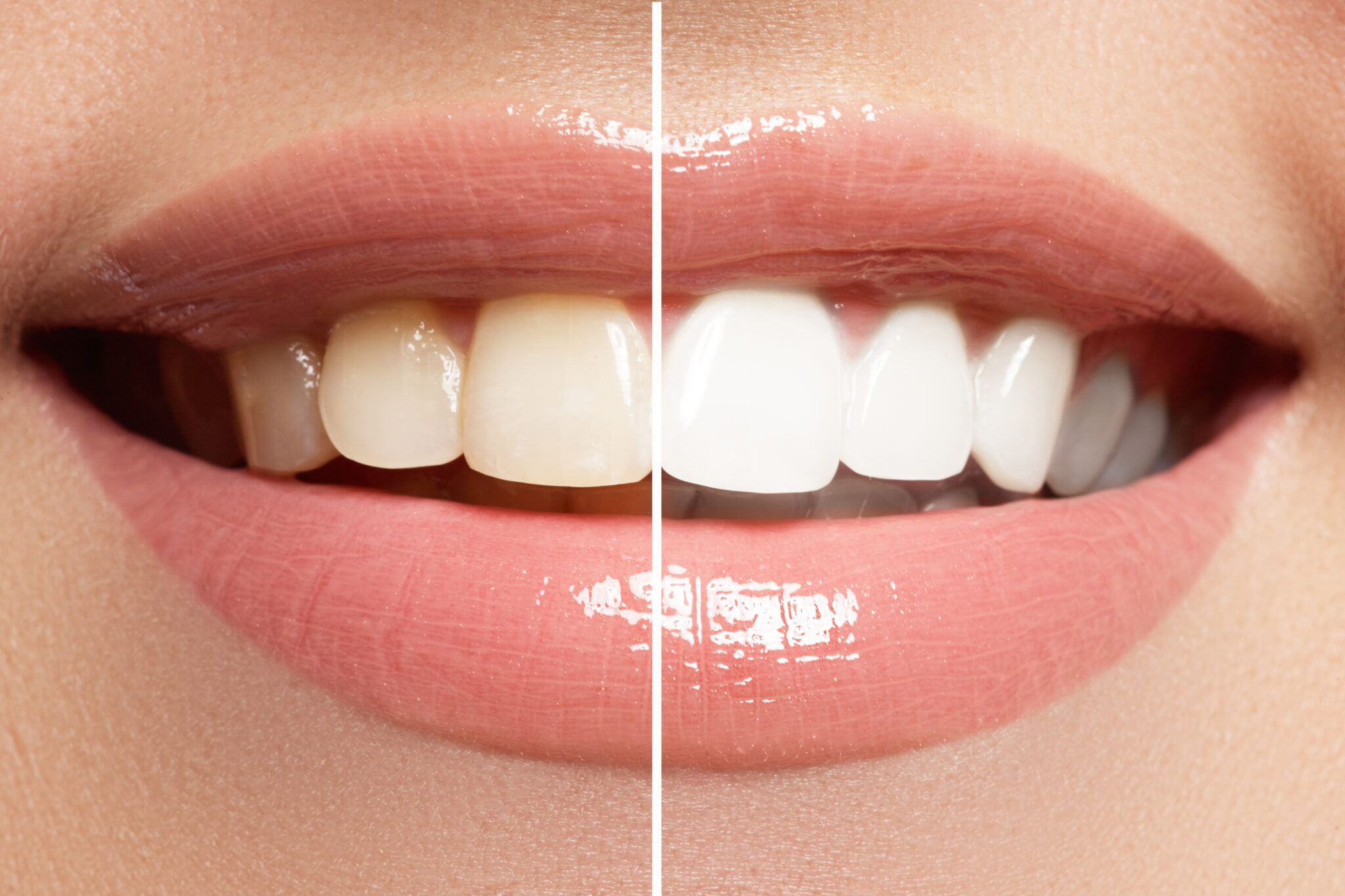 TOOTH WHITENING