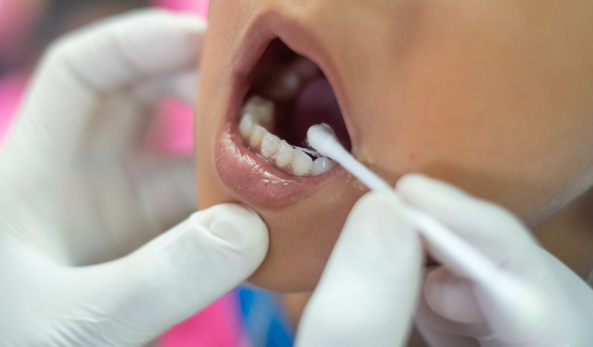 HOW CAN WE AVOID A CAVITY? PART I: USE FLUORIDE