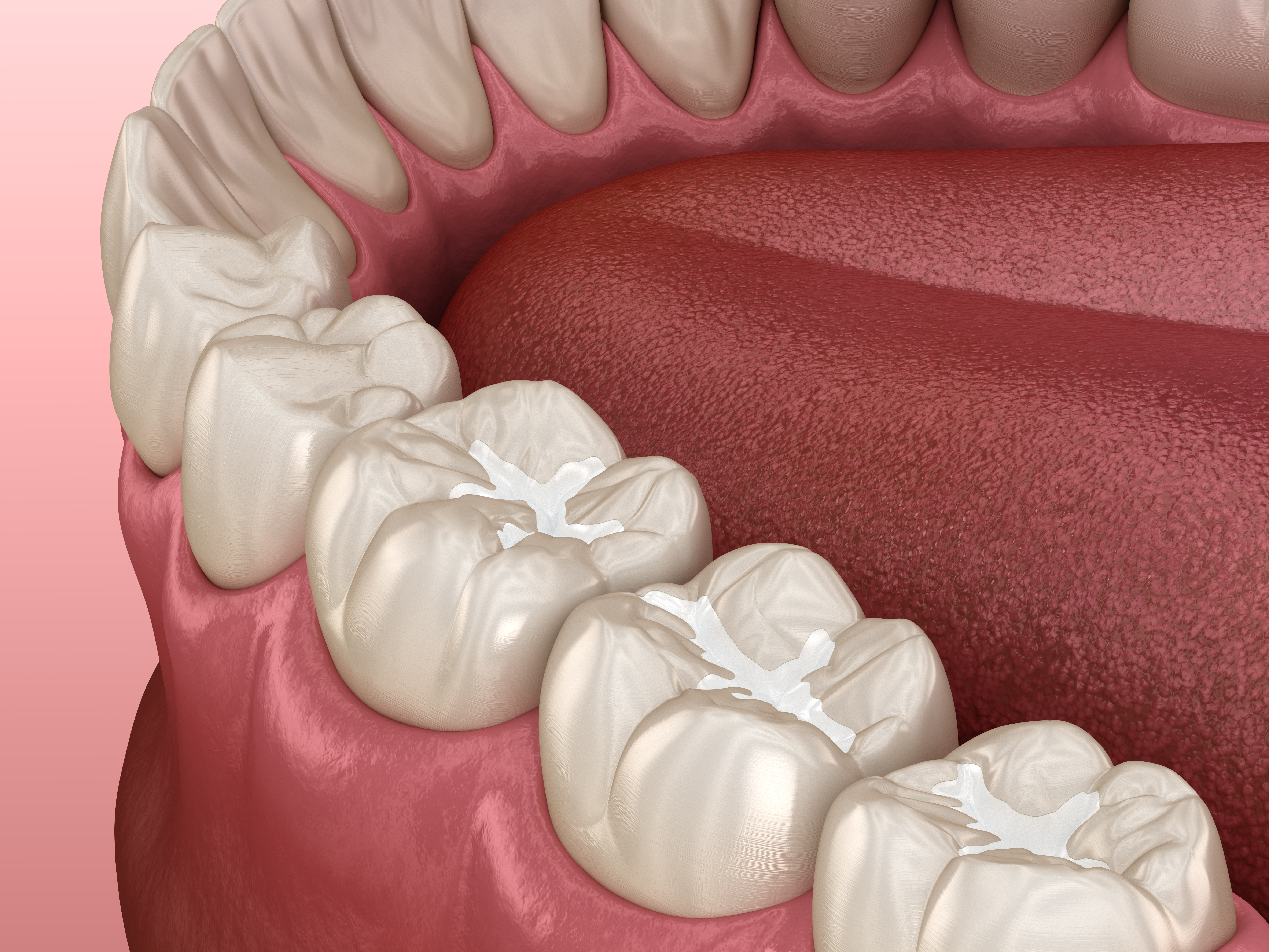 HOW CAN WE AVOID A CAVITY? PART IV: SEALANTS