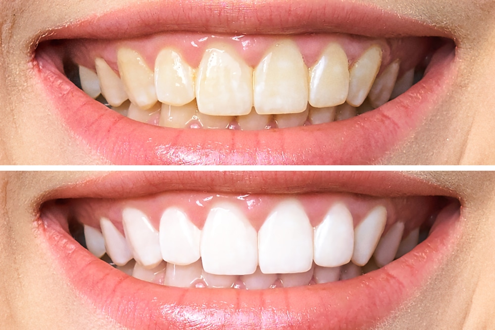 WHITER TEETH