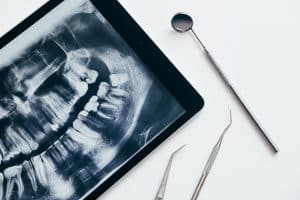 Digital Dental X-Rays and Digital Impressions: A Better Visit from Start to Finish